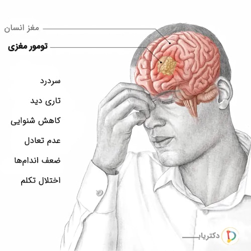 علائم تومور مغزی