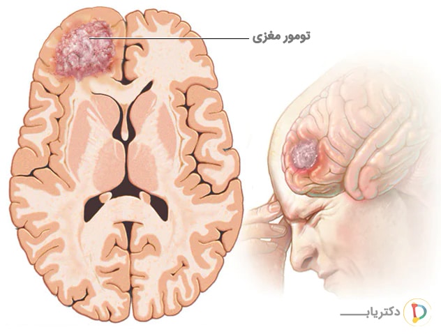 تومور مغزی