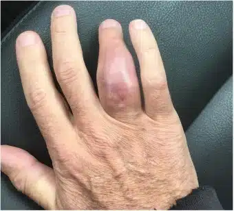 عفونت استخوان خطرناک است