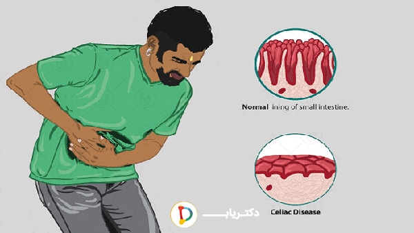 علت بیماری سلیاک