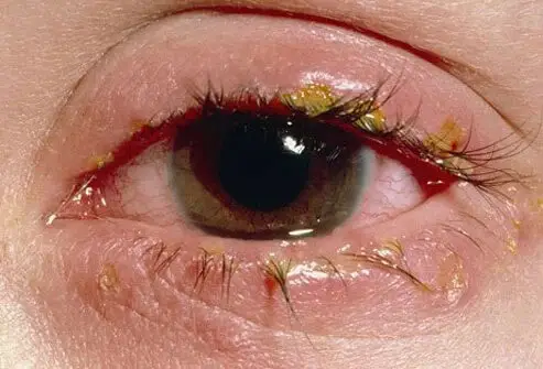 عفونت چشم
