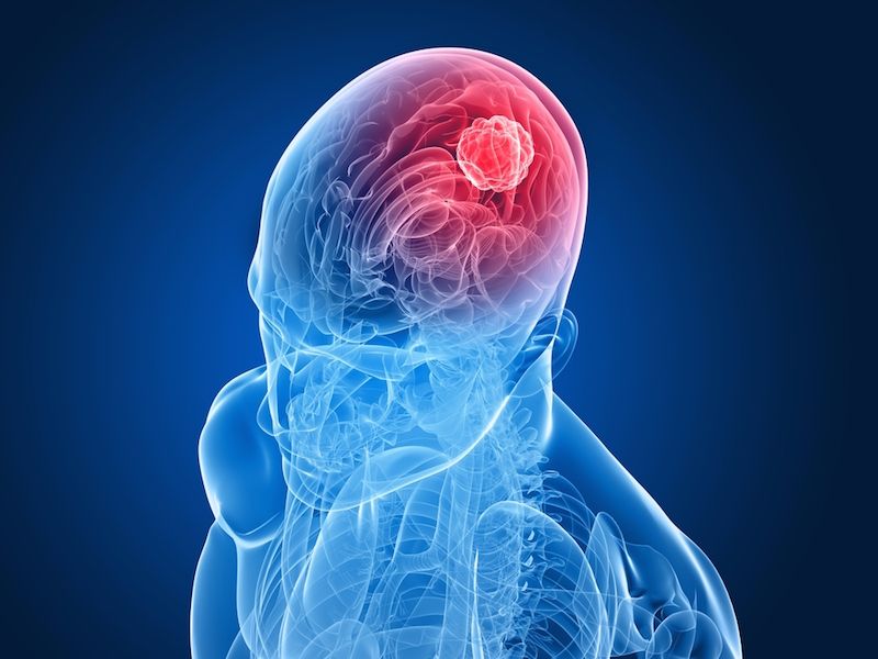آیا تومور مغزی خوش خیم قابل درمان است ؟