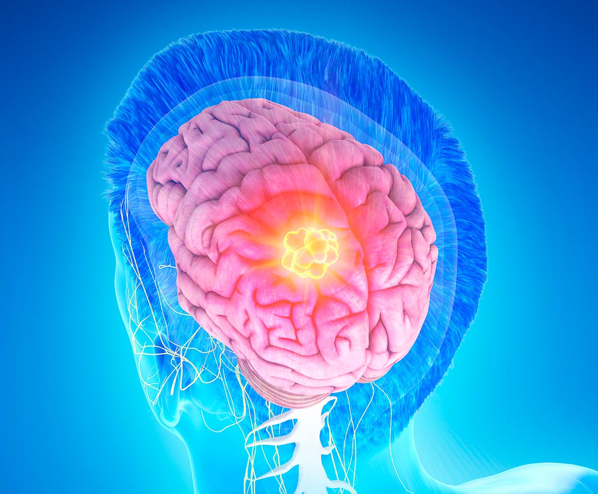 آیا تومور مغزی باعث فلج شدن می شود ؟