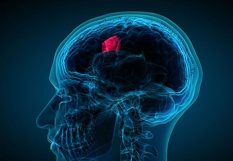 آیا تومور مغزی باعث کاهش وزن می شود ؟