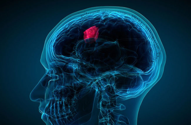 آیا تومورهای مغزی بدخیم قابل درمان است ؟
