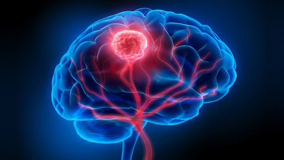 در تومور مغزی کجای سردرد میگیره ؟