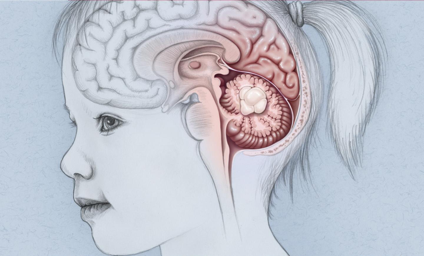 انواع تومورهای مغزی در کودکان