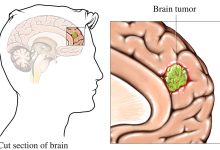 درباره تومور مغزی بدخیم