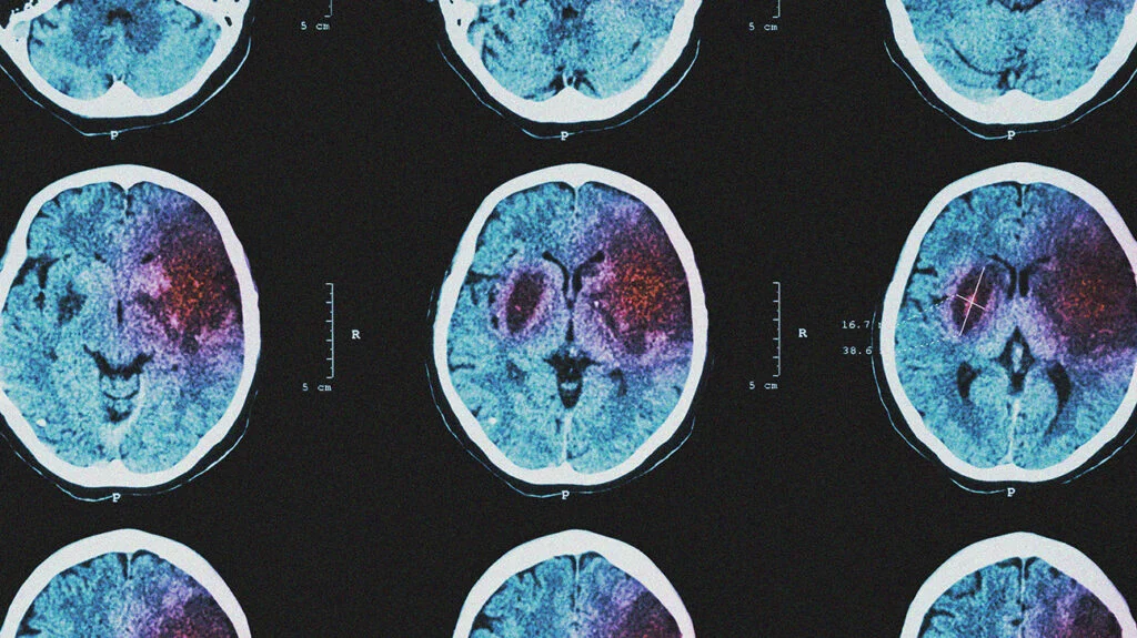 آیا تومور باعث سکته مغزی می شود ؟