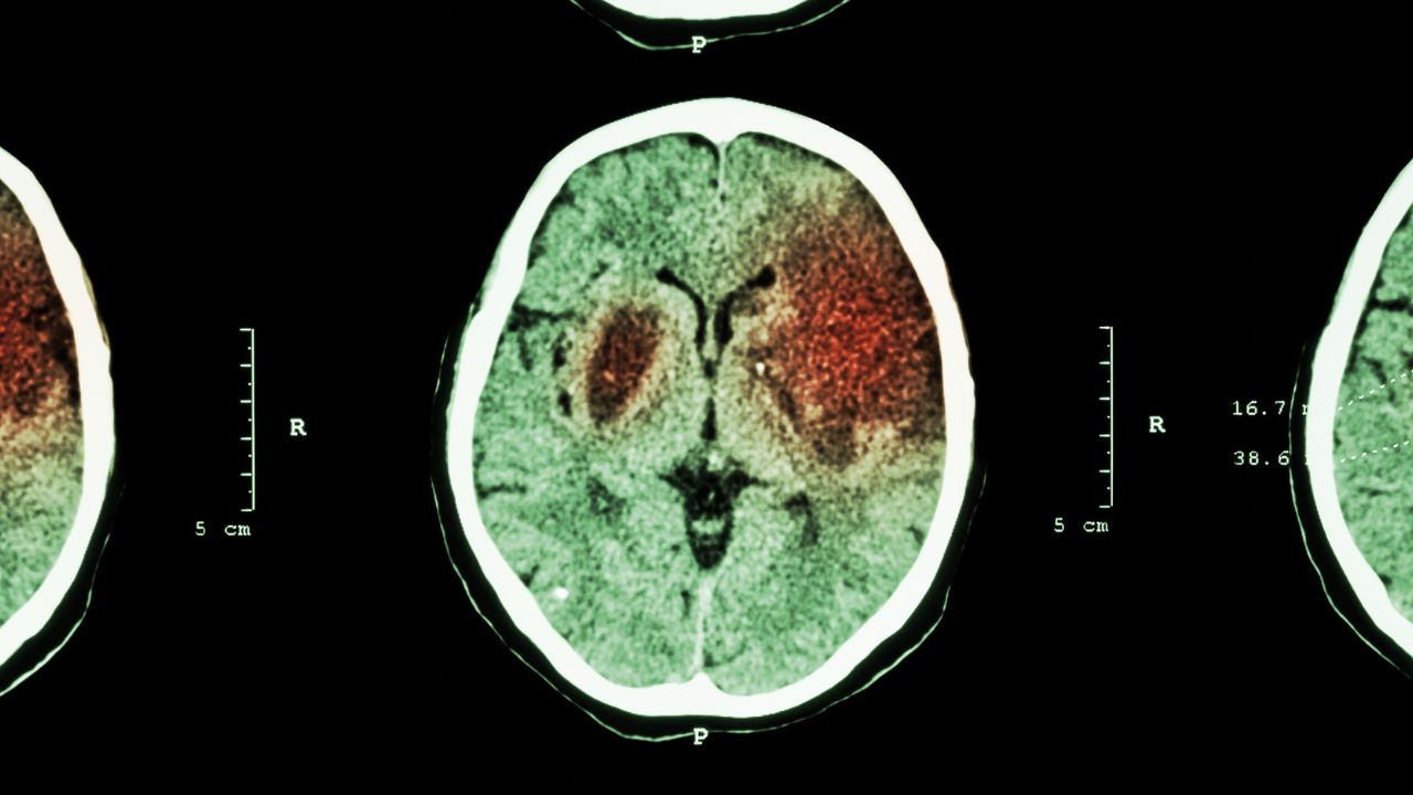 آیا تومور مغزی باعث توهم می شود ؟
