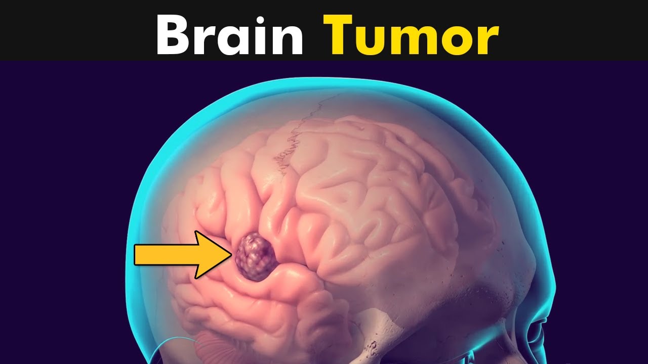 اسم انواع تومورهای مغزی