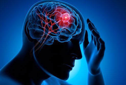 آیا تومور مغزی باعث سردرد می شود ؟