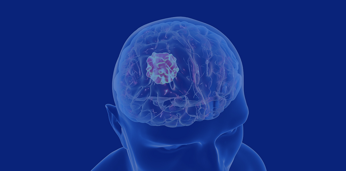 آیا تومور مغزی باعث تشنج می شود ؟