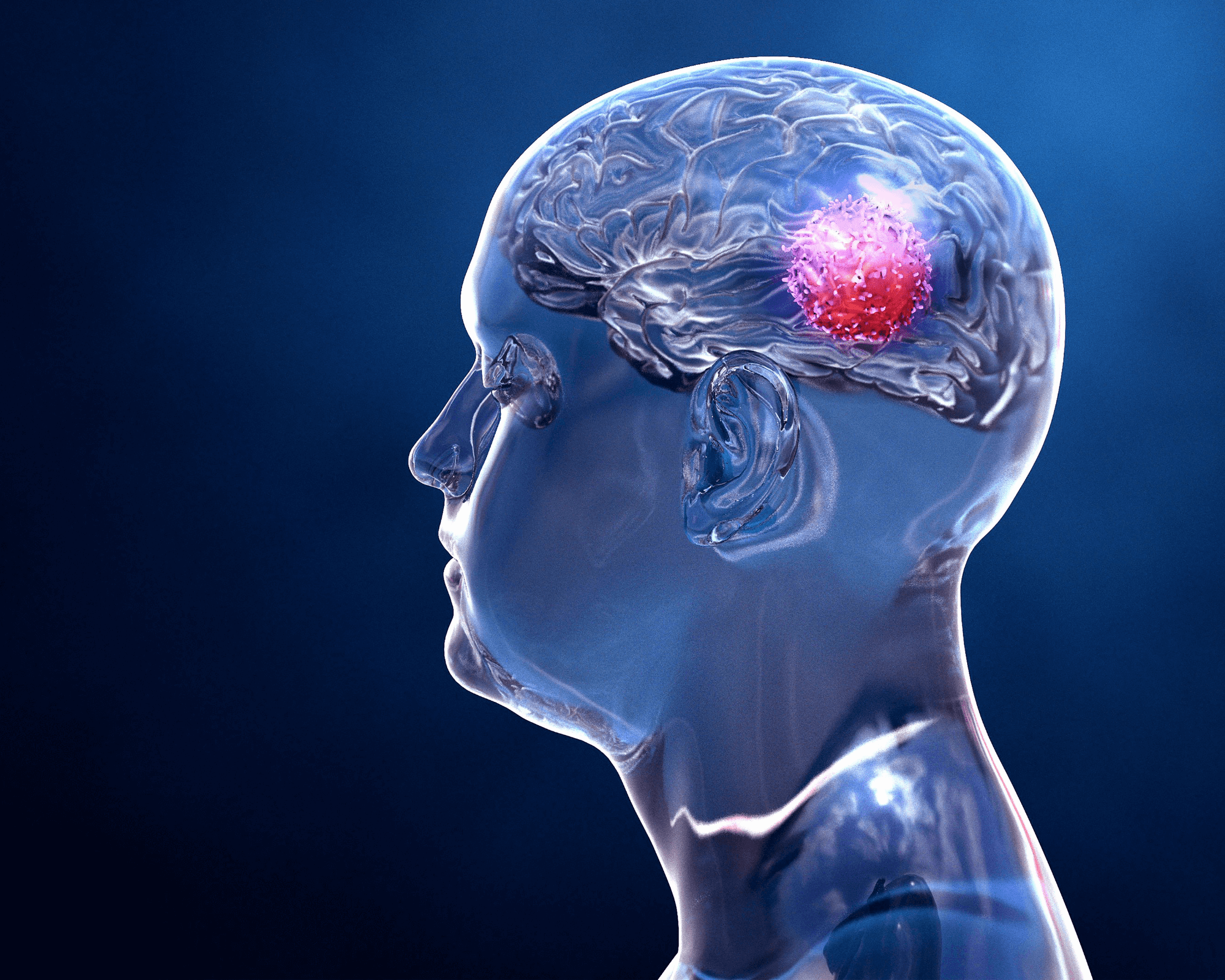 آیا تومور مغزی باعث سرگیجه می شود ؟