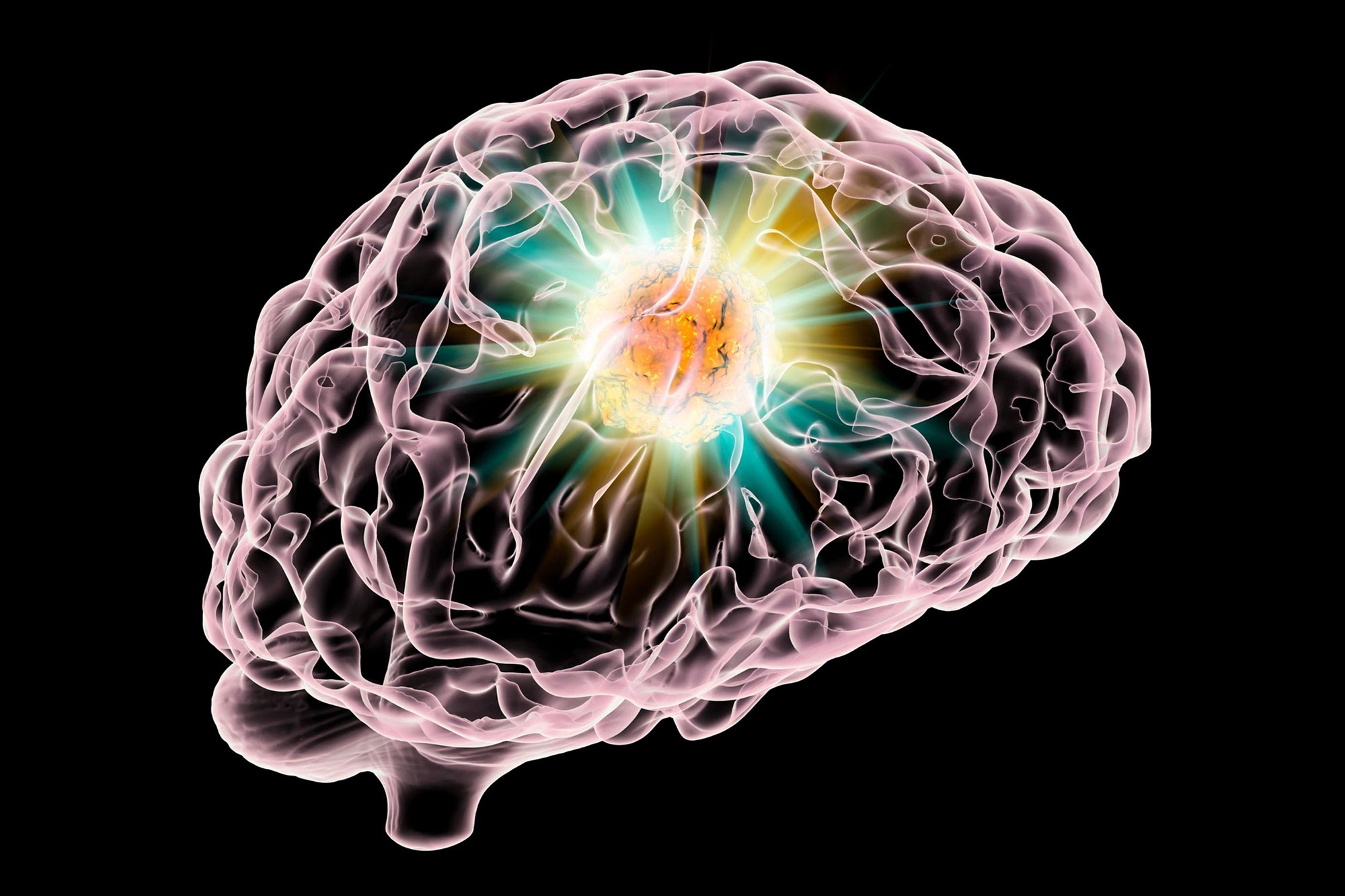 چگونه از تومور مغزی جلوگیری کنیم ؟