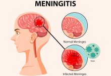 آیا بیماری مننژیت قابل درمان است ؟