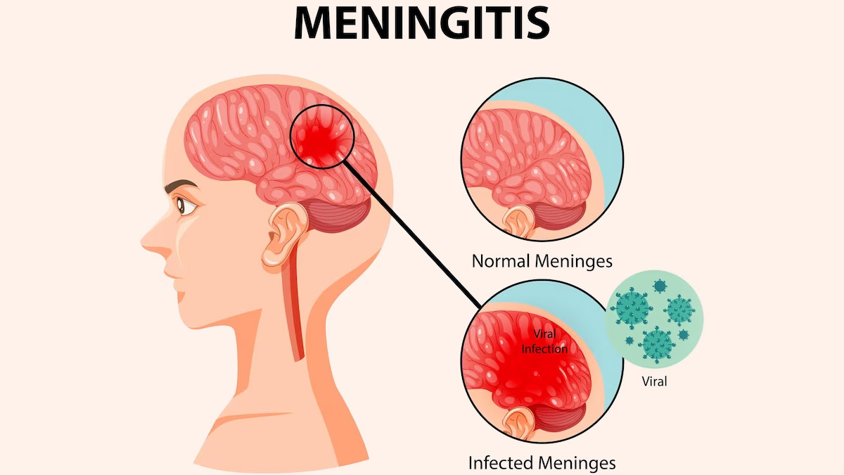 آیا بیماری مننژیت قابل درمان است ؟