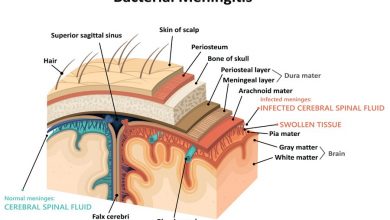 مننژیت چیست؟ آشنایی با علائم، علت‌ها، پیشگیری و درمان
