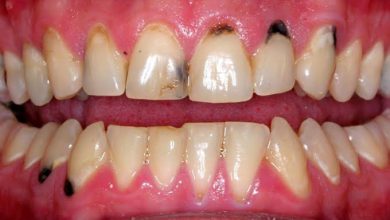 چگونه سیاه شدن دندان را از بین ببریم ؟