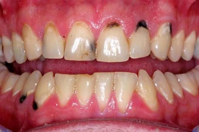 چگونه سیاه شدن دندان را از بین ببریم ؟