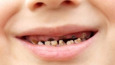 جلوگیری از سیاه شدن دندان کودک