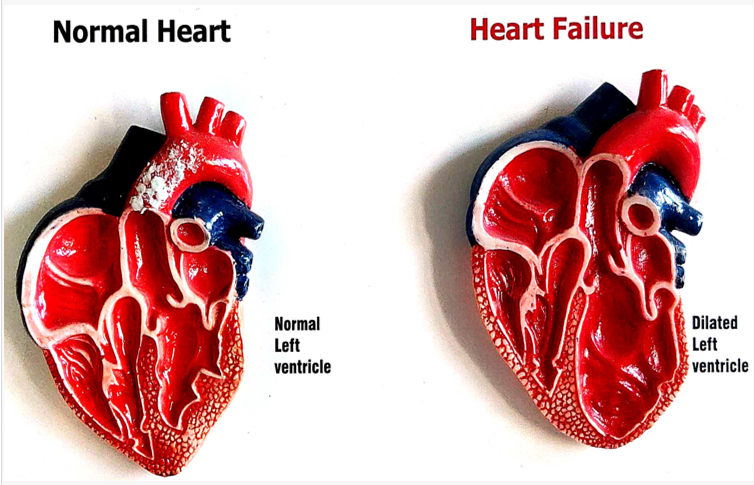 علت نارسایی قلبی