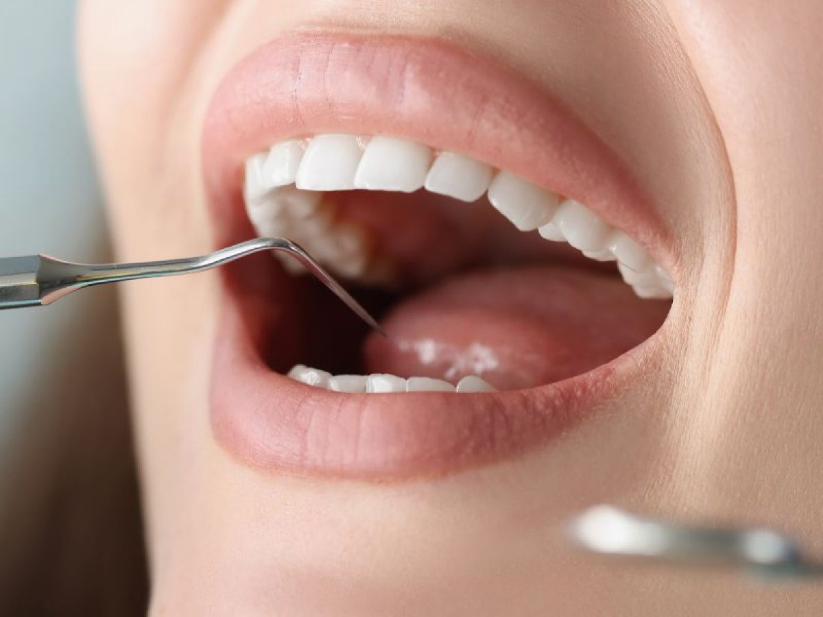 آیا سیپروهپتادین باعث پوسیدگی دندان می شود ؟