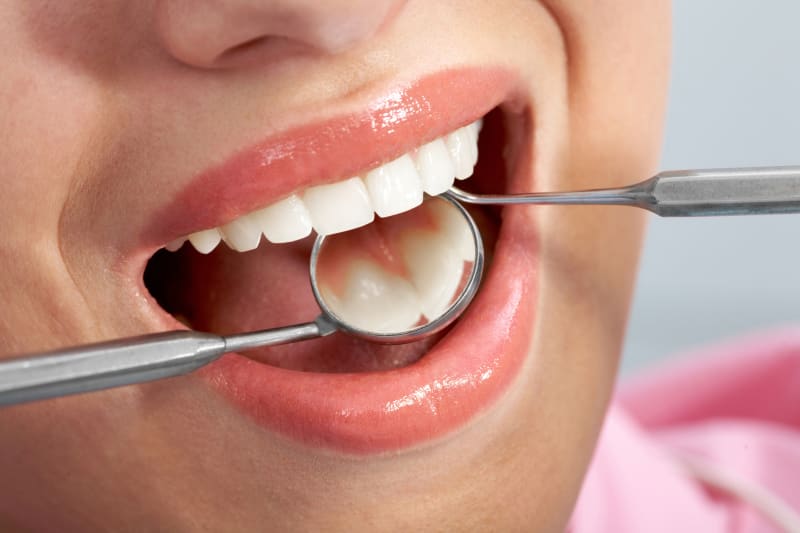 آیا کامپوزیت از پوسیدگی دندان جلوگیری می کند ؟