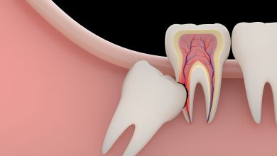 آیا دندان عقل نهفته عفونت میکند ؟