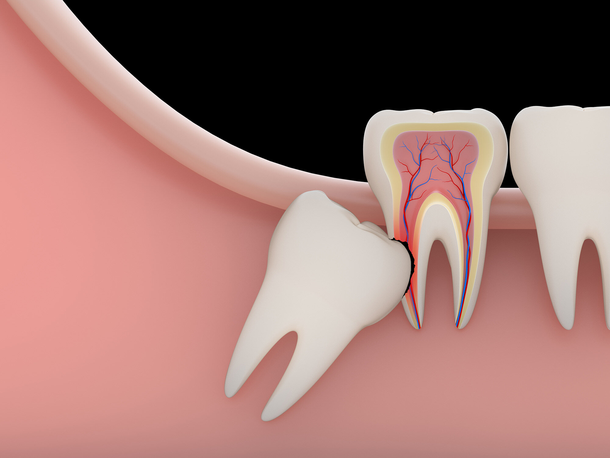 آیا دندان عقل نهفته عفونت میکند ؟