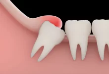 آیا دندان عقل نیمه نهفته را باید کشید ؟