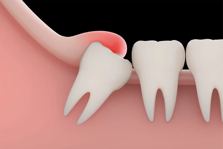 آیا دندان عقل نیمه نهفته را باید کشید ؟
