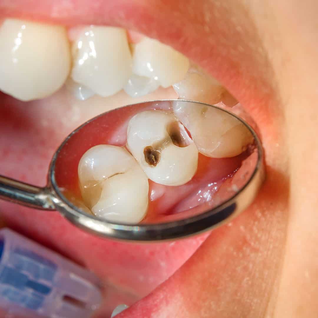 آیا پوسیدگی دندان باعث بوی بد دهان می شود ؟