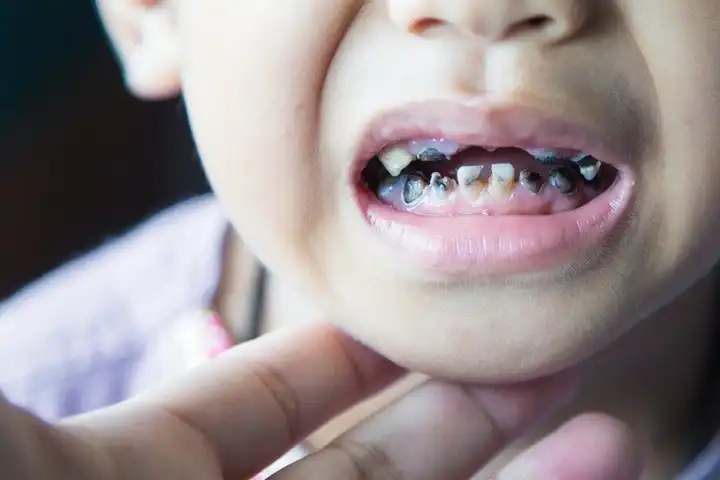 برای درمان پوسیدگی دندان کودکان چه باید کرد ؟
