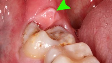 آیا عفونت دندان عقل باعث گلو درد می شود ؟