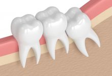 بعد از جراحی دندان عقل نهفته چه باید کرد ؟