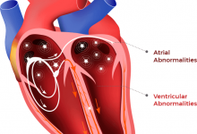چه چیزهایی برای آریتمی قلب مضر است ؟
