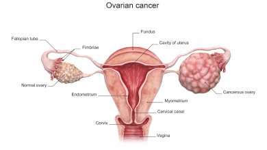 سرطان تخمدان چگونه به وجود می آید ؟