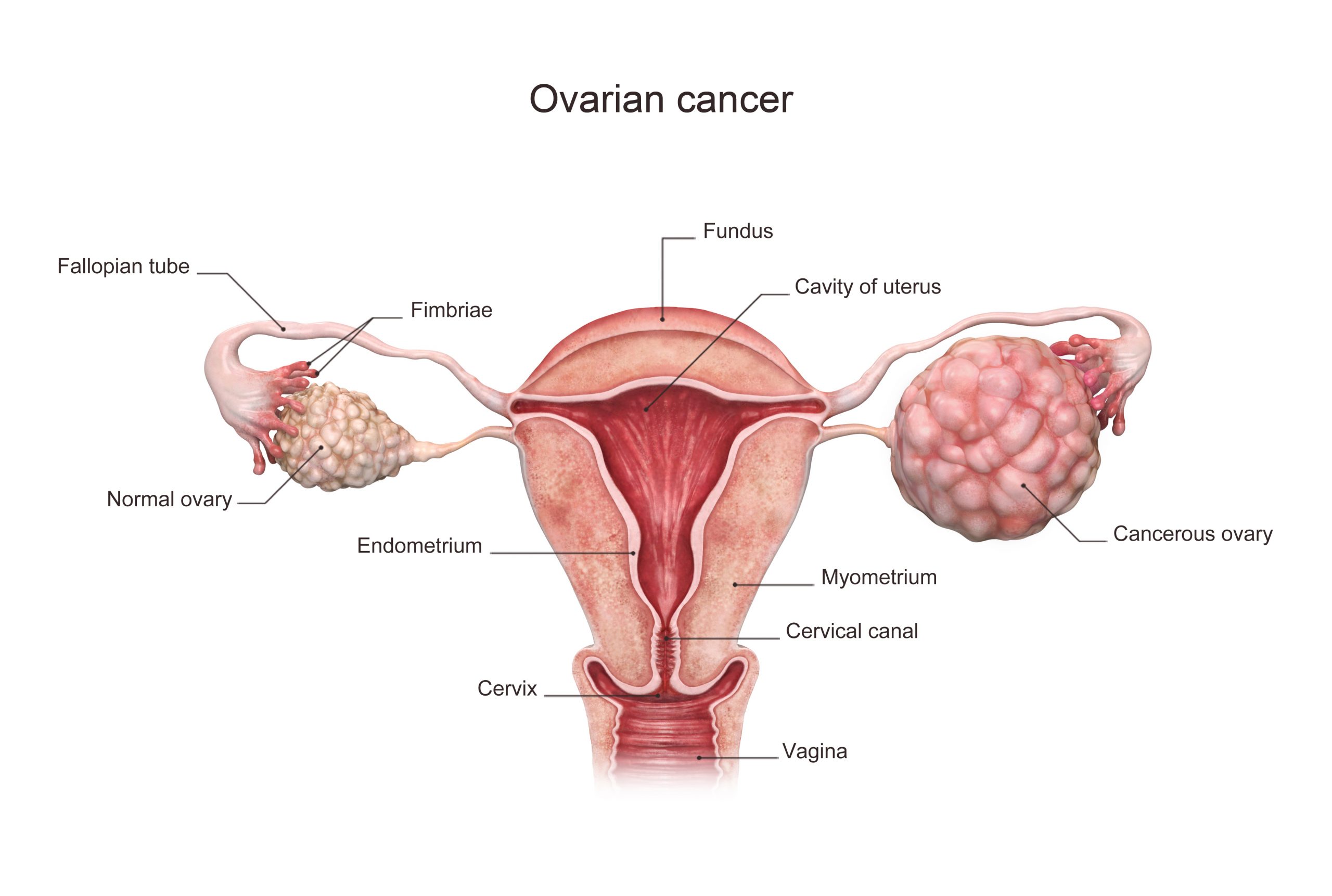 سرطان تخمدان چگونه به وجود می آید ؟