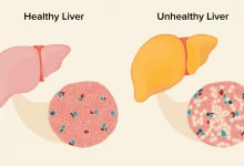 آیا کبد چرب تبدیل به سرطان می شود ؟