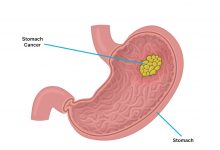 برای پیشگیری از سرطان معده چه باید کرد ؟