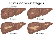 سرطان کبد چگونه به وجود می آید ؟