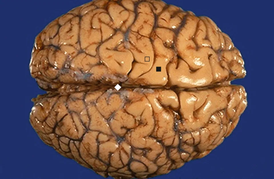 علائم ورم مغزی چگونه است؟