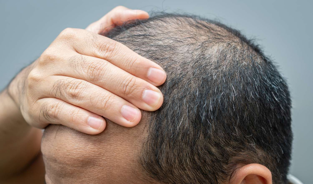 استراتژی‌های تقویت سلامت مو در شرایط سنگ کیسه صفرا