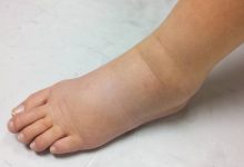 علت ورم پای راست چیست