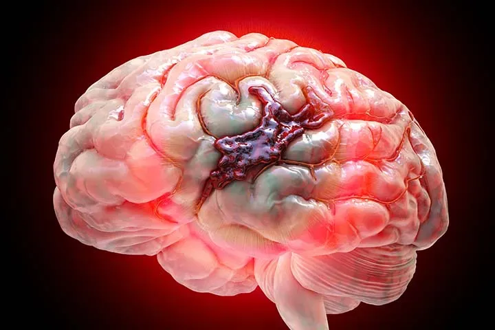 خونریزی مغزی چه زمانی اتفاق می افتد؟ آیا درمان پیدا میکند؟
