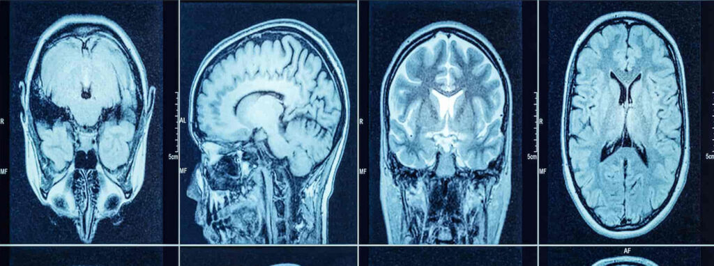 عفونت مغزی چیست؟