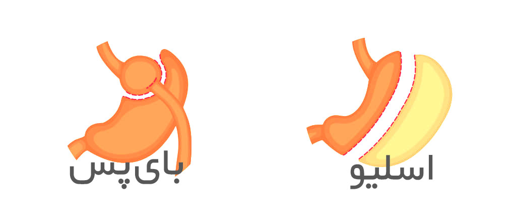 تفاوت اسلیو و بای پس معده