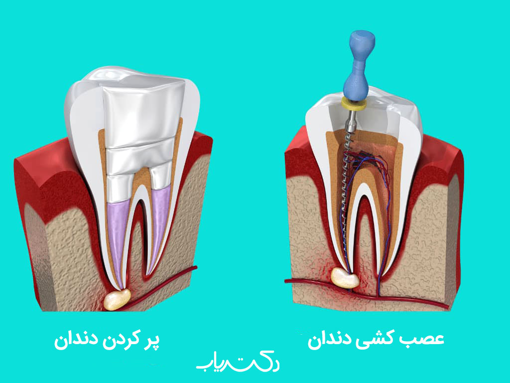 تفاوت عصب کشی و پر کردن دندان