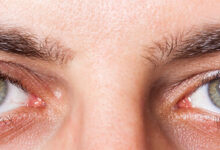 علت و درمان خشکی چشم